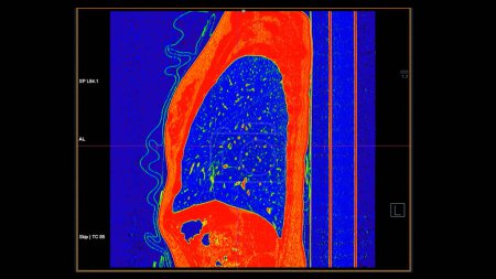 CT scan of Chest sagittal view in color mode for diagnostic Embolie pulmonaire (EP), cancer du poumon et covide-19. 