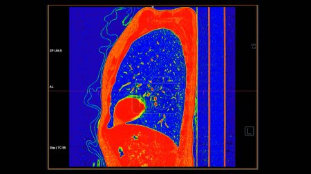 CT scan of Chest sagittal view in color mode  for diagnostic Pulmonary embolism (PE) , lung cancer and covid-19. 
