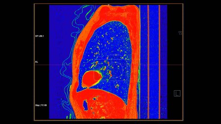 CT scan of Chest sagittal view in color mode  for diagnostic Pulmonary embolism (PE) , lung cancer and covid-19. 