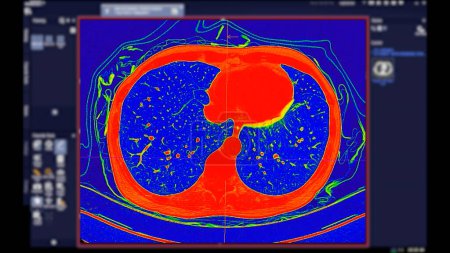CT scan of Chest Axial view in color mode for diagnostic Embolie pulmonaire (EP), cancer du poumon et covide-19. 