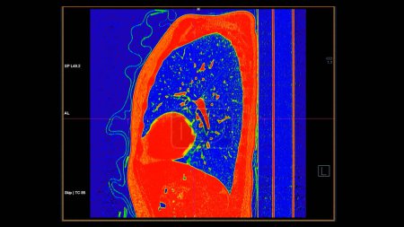 CT scan of Chest sagittal view in color mode for diagnostic Embolie pulmonaire (EP), cancer du poumon et covide-19. 