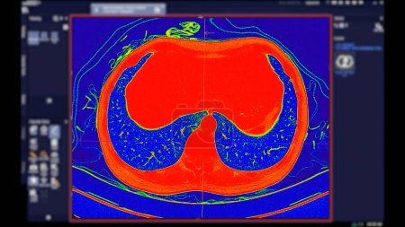 CT der Brust Axiale Ansicht im Farbmodus für diagnostische Lungenembolie (PE), Lungenkrebs und Covid-19. 