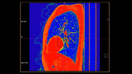 Tomografía computarizada de la vista sagital torácica en modo de color para el diagnóstico de embolia pulmonar (EP), cáncer de pulmón y covid-19. 