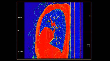CT Scan der Brust sagittale Ansicht im Farbmodus für diagnostische Lungenembolie (PE), Lungenkrebs und Covid-19. 