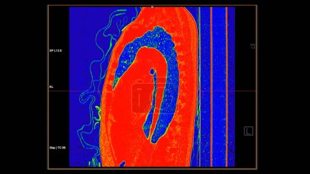 Téléchargez les photos : CT scan of Chest sagittal view in color mode for diagnostic Embolie pulmonaire (EP), cancer du poumon et covide-19. - en image libre de droit