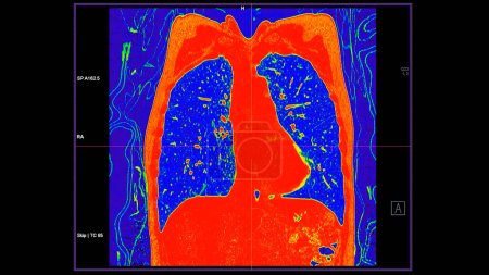 CT der Brust koronale Ansicht im Farbmodus für diagnostische Lungenembolie (PE), Lungenkrebs und Covid-19. 