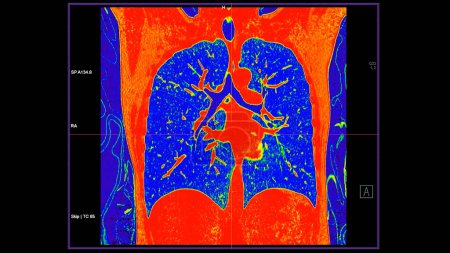 Foto de Tomografía computarizada de la vista coronal del tórax en modo de color para el diagnóstico de embolia pulmonar (EP), cáncer de pulmón y covid-19. - Imagen libre de derechos