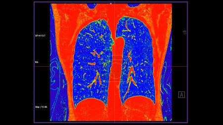 CT scan of Chest coronal view in color mode  for diagnostic Pulmonary embolism (PE) , lung cancer and covid-19. 