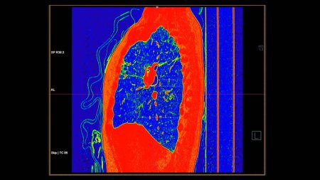 Téléchargez les photos : CT scan of Chest sagittal view in color mode for diagnostic Embolie pulmonaire (EP), cancer du poumon et covide-19. - en image libre de droit