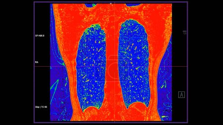 CT der Brust koronale Ansicht im Farbmodus für diagnostische Lungenembolie (PE), Lungenkrebs und Covid-19. 