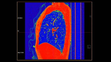 Photo for CT scan of Chest sagittal view in color mode  for diagnostic Pulmonary embolism (PE) , lung cancer and covid-19. - Royalty Free Image
