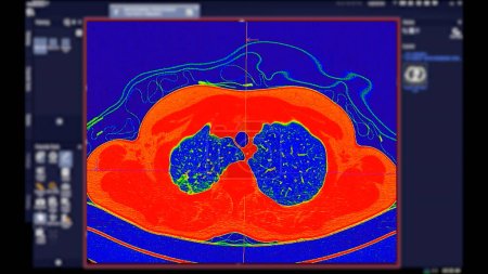 CT der Brust Axiale Ansicht im Farbmodus für diagnostische Lungenembolie (PE), Lungenkrebs und Covid-19. 
