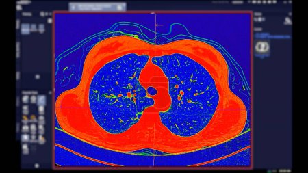 Téléchargez les photos : CT scan of Chest Axial view in color mode for diagnostic Embolie pulmonaire (EP), cancer du poumon et covide-19. - en image libre de droit