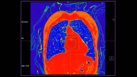 CT scan of Chest coronal view in color mode for diagnostic Embolie pulmonaire (EP), cancer du poumon et covide-19. 