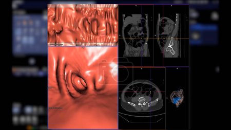 Téléchargez les photos : CT colonography, Cette technique d'imagerie est souvent utilisée pour le dépistage du cancer colorectal, fournissant des images détaillées de l'intérieur du côlon rendu 3D. - en image libre de droit