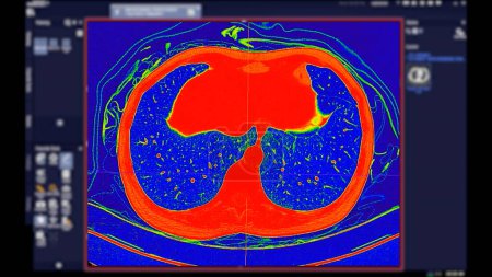 Téléchargez les photos : CT scan of Chest Axial view in color mode for diagnostic Embolie pulmonaire (EP), cancer du poumon et covide-19. - en image libre de droit