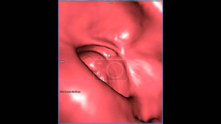 CT-Kolonographie, Diese bildgebende Technik wird häufig zur Darmkrebsvorsorge eingesetzt und liefert detaillierte Bilder des Dickdarminneren in 3D-Darstellung.