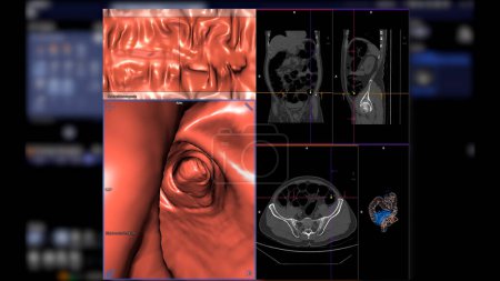 Téléchargez les photos : CT colonography, Cette technique d'imagerie est souvent utilisée pour le dépistage du cancer colorectal, fournissant des images détaillées de l'intérieur du côlon rendu 3D. - en image libre de droit