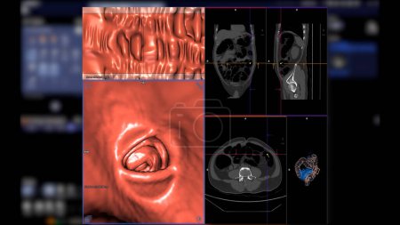 CT-Kolonographie, Diese bildgebende Technik wird häufig zur Darmkrebsvorsorge eingesetzt und liefert detaillierte Bilder des Dickdarminneren in 3D-Darstellung.