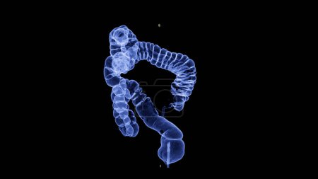 Colonografía por TC, Esta técnica de imagen se utiliza a menudo para el cribado del cáncer colorrectal, proporcionando imágenes detalladas de la representación 3D interior del colon.