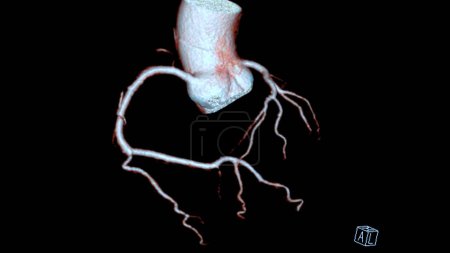 Photo for CTA coronary artery 3D rendering is a diagnostic imaging technique capturing detailed visuals of the heart's blood vessels in diagnosing coronary artery diseases and assessing cardiac health. - Royalty Free Image