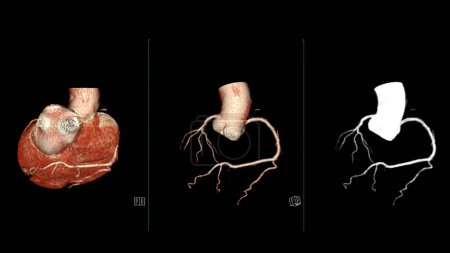 El renderizado 3D de la arteria coronaria CTA es una técnica de diagnóstico por imágenes que captura imágenes detalladas de los vasos sanguíneos del corazón en el diagnóstico de enfermedades de las arterias coronarias y la evaluación de la salud cardíaca..
