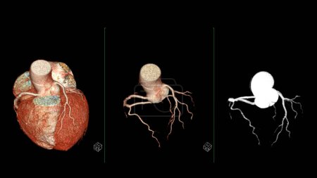 CTA koronare Arterie 3D-Rendering ist eine bildgebende Diagnosetechnik, die detaillierte Visualisierungen der Blutgefäße des Herzens bei der Diagnose koronarer Herzkrankheiten und der Beurteilung der Herzgesundheit erfasst.