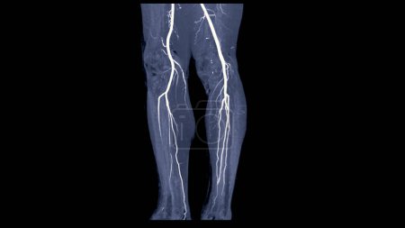 CTA femoral artery run off image of femoral artery for diagnostic Acute or Chronic Peripheral Arterial Disease.