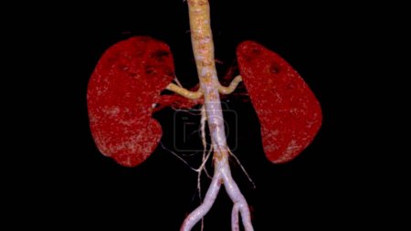 CTA Renal artery 3D is a medical imaging procedure using CT scans to examine the renal arteries It provides detailed images of the blood vessels supplying the kidneys.