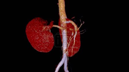 Téléchargez les photos : CTA artère rénale 3D est une procédure d'imagerie médicale utilisant des tomodensitogrammes pour examiner les artères rénales Il fournit des images détaillées des vaisseaux sanguins alimentant les reins. - en image libre de droit