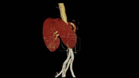 CTA Renal Artery 3D ist ein medizinisches bildgebendes Verfahren zur Untersuchung der Nierenarterien mittels CT. Es liefert detaillierte Bilder der Blutgefäße, die die Nieren versorgen.