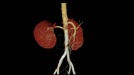 Foto de CTA La arteria renal 3D es un procedimiento de imagen médica que utiliza tomografías computarizadas para examinar las arterias renales. Proporciona imágenes detalladas de los vasos sanguíneos que irrigan los riñones.. - Imagen libre de derechos