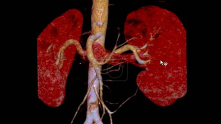 CTA Renal artery 3D is a medical imaging procedure using CT scans to examine the renal arteries It provides detailed images of the blood vessels supplying the kidneys.