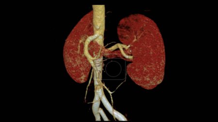 CTA Renal Artery 3D ist ein medizinisches bildgebendes Verfahren zur Untersuchung der Nierenarterien mittels CT. Es liefert detaillierte Bilder der Blutgefäße, die die Nieren versorgen.