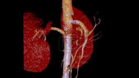 Téléchargez les photos : CTA artère rénale 3D est une procédure d'imagerie médicale utilisant des tomodensitogrammes pour examiner les artères rénales Il fournit des images détaillées des vaisseaux sanguins alimentant les reins. - en image libre de droit