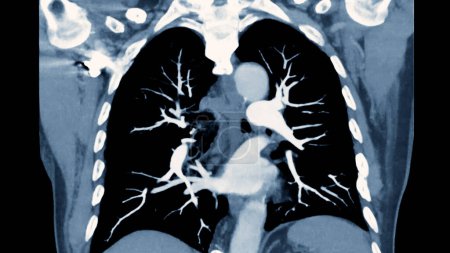 CTPA o CTA arteria pulmonar.Esta técnica de imagen ofrece una visión clara de las arterias pulmonares, ayudando en el diagnóstico de embolia pulmonar, afecciones vasculares y otros problemas respiratorios.