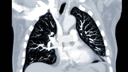 Photo for CTPA or CTA pulmonary artery .This imaging technique offers a clear view of the pulmonary arteries, aiding in the diagnosis of pulmonary embolism, vascular conditions, and other respiratory issues. - Royalty Free Image