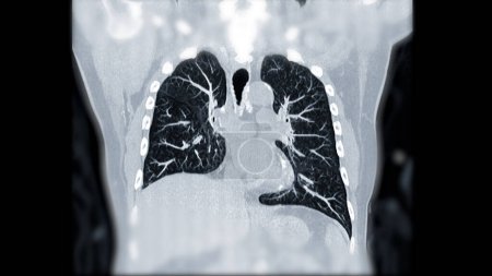 Photo for CTPA or CTA pulmonary artery .This imaging technique offers a clear view of the pulmonary arteries, aiding in the diagnosis of pulmonary embolism, vascular conditions, and other respiratory issues. - Royalty Free Image