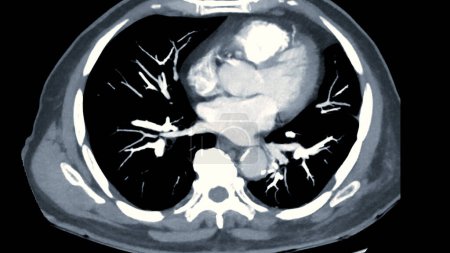 CTPA o CTA arteria pulmonar.Esta técnica de imagen ofrece una visión clara de las arterias pulmonares, ayudando en el diagnóstico de embolia pulmonar, afecciones vasculares y otros problemas respiratorios.