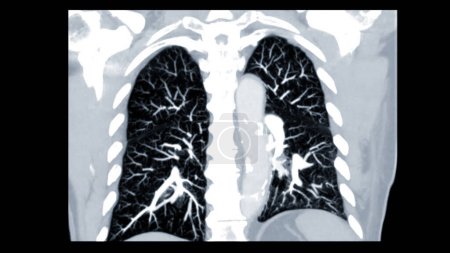 CTPA ou CTA artère pulmonaire Cette technique d'imagerie offre une vision claire des artères pulmonaires, aidant au diagnostic de l'embolie pulmonaire, des affections vasculaires et d'autres problèmes respiratoires..