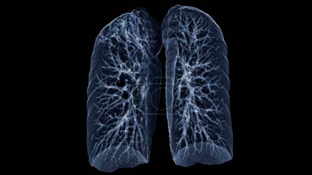 Photo for CT Chest or Lung 3d rendering image  showing Trachea and lung in respiratory system. - Royalty Free Image