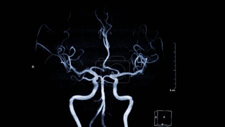 MRA Brain , This imaging technique provides clear visuals of the brain's arterial and venous structures, aiding in the diagnosis of vascular conditions and neurological issues.