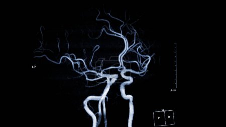 MRA Brain, Diese bildgebende Technik bietet klare Visualisierungen der arteriellen und venösen Strukturen des Gehirns und hilft bei der Diagnose von Gefäßerkrankungen und neurologischen Problemen.
