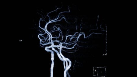 MRA Brain, Diese bildgebende Technik bietet klare Visualisierungen der arteriellen und venösen Strukturen des Gehirns und hilft bei der Diagnose von Gefäßerkrankungen und neurologischen Problemen.