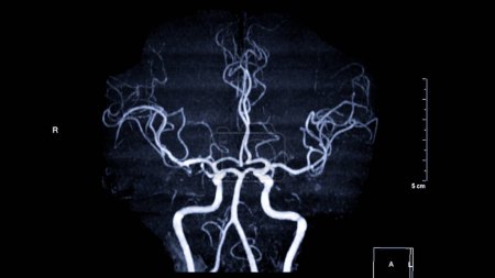 Téléchargez les photos : MRA Brain, Cette technique d'imagerie fournit des images claires des structures artérielles et veineuses du cerveau, aidant au diagnostic des affections vasculaires et des problèmes neurologiques. - en image libre de droit