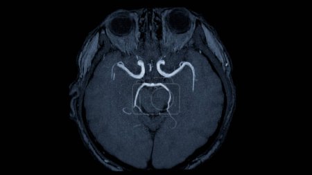 MRA Vue axiale du cerveau, Cette technique d'imagerie fournit des images claires des structures artérielles et veineuses du cerveau, aidant au diagnostic des affections vasculaires et des problèmes neurologiques.