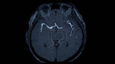 MRA Vista axial cerebral, Esta técnica de imagen proporciona imágenes claras de las estructuras arteriales y venosas del cerebro, ayudando en el diagnóstico de afecciones vasculares y problemas neurológicos.