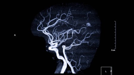 MRA Cerebro, Esta técnica de imagen proporciona imágenes claras de las estructuras arteriales y venosas del cerebro, ayudando en el diagnóstico de condiciones vasculares y problemas neurológicos.
