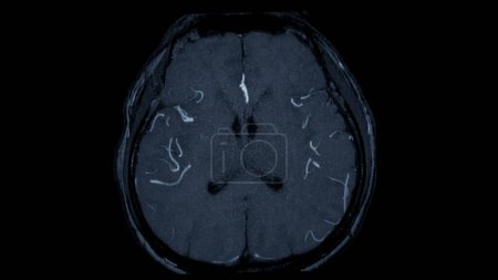 Téléchargez les photos : MRA Vue axiale du cerveau, Cette technique d'imagerie fournit des images claires des structures artérielles et veineuses du cerveau, aidant au diagnostic des affections vasculaires et des problèmes neurologiques. - en image libre de droit