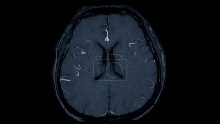 Foto de MRA Vista axial cerebral, Esta técnica de imagen proporciona imágenes claras de las estructuras arteriales y venosas del cerebro, ayudando en el diagnóstico de afecciones vasculares y problemas neurológicos. - Imagen libre de derechos